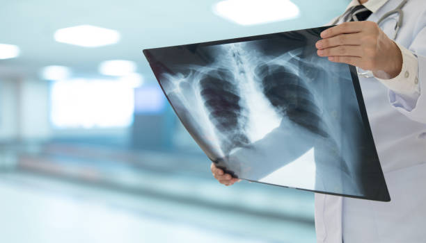 doctor holding x-ray of lungs
